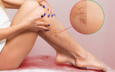 Varices