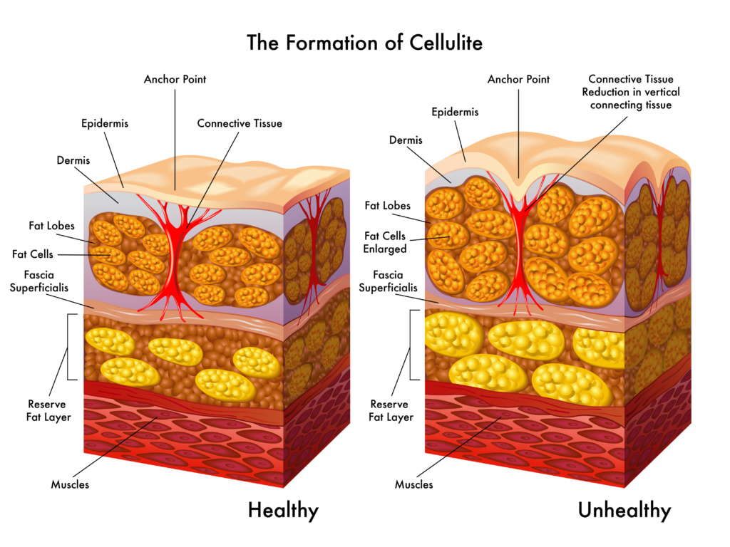 celulitis formación